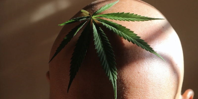 Does cannabis work on alopecia sufferers? This is what science has to say!